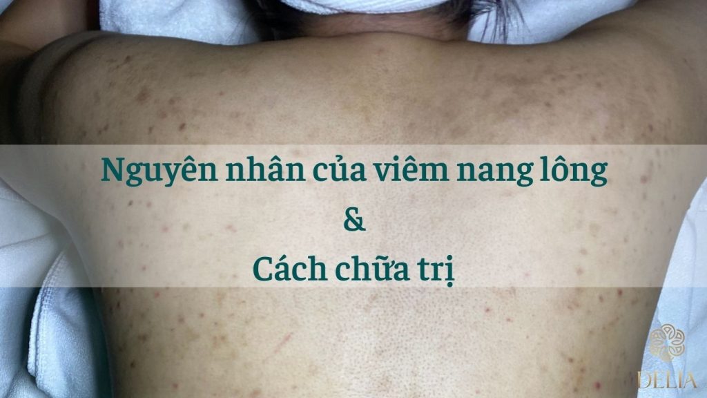 viêm nang lông