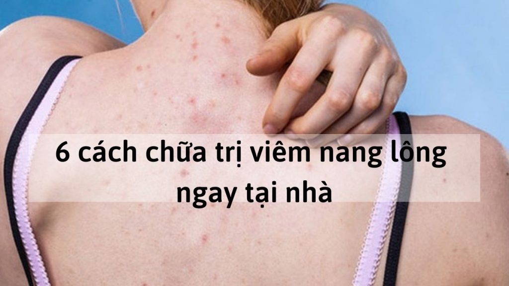 viêm nang lông